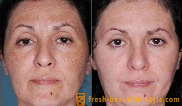 Bucce di acido per il viso: recensioni, foto prima e dopo