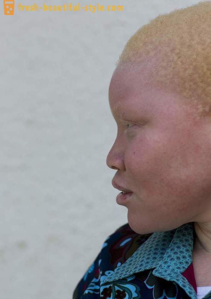 La tragica storia della Tanzania gli albini