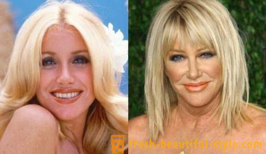 15 celebrità, finito male con Botox