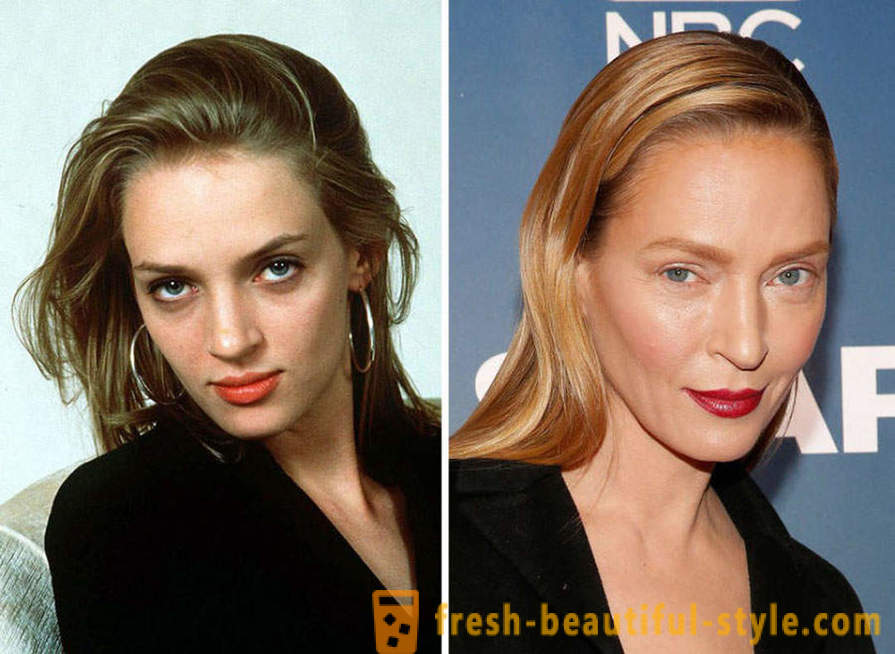 15 celebrità, finito male con Botox