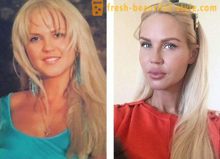 10 bellezze russe, prima e dopo di plastica