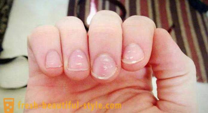 Macchie bianche sulle unghie delle dita: le cause e trattamenti