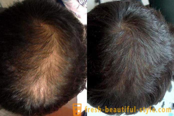 Farmaci con minoxidil per capelli: recensioni, caratteristiche e descrizione dell'applicazione delle migliori