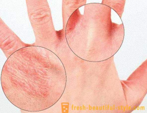 La pelle secca delle mani: Causa. Molto pelle secca, cosa fare?