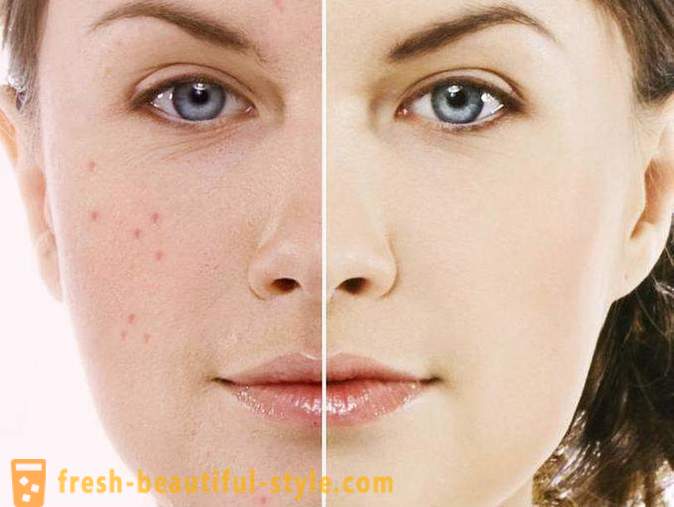 Badyaga macchia di acne: recensioni. Badyaga (gel) di macchie di età