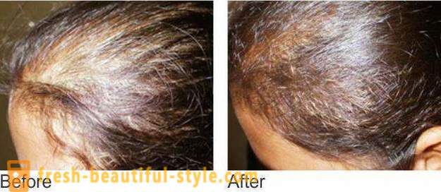 Mesoterapia per capelli: Strumenti di trucco e controindicazioni