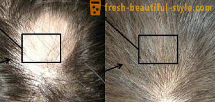 Mesoterapia per capelli: Strumenti di trucco e controindicazioni
