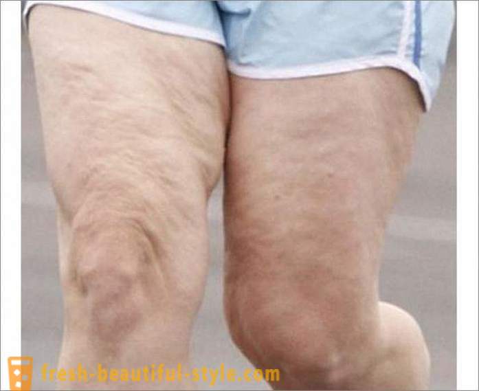 Come sbarazzarsi di cellulite sulle gambe? Esercizi per le gambe di cellulite