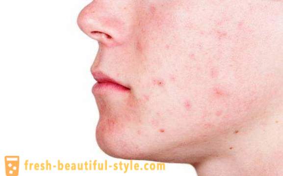 Come liberarsi di acne e tracce di loro. Come sbarazzarsi di acne su diverse zone della pelle