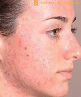 Come sbarazzarsi di tracce dopo acne e ripristinare la pelle bella vista?