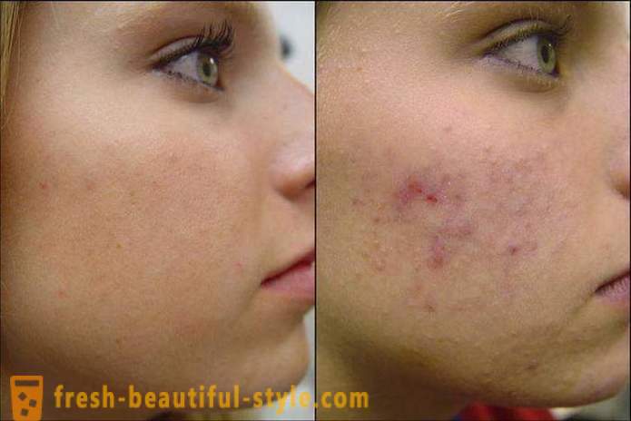 Come pulire il viso di acne in modo che essi non sono più tornati